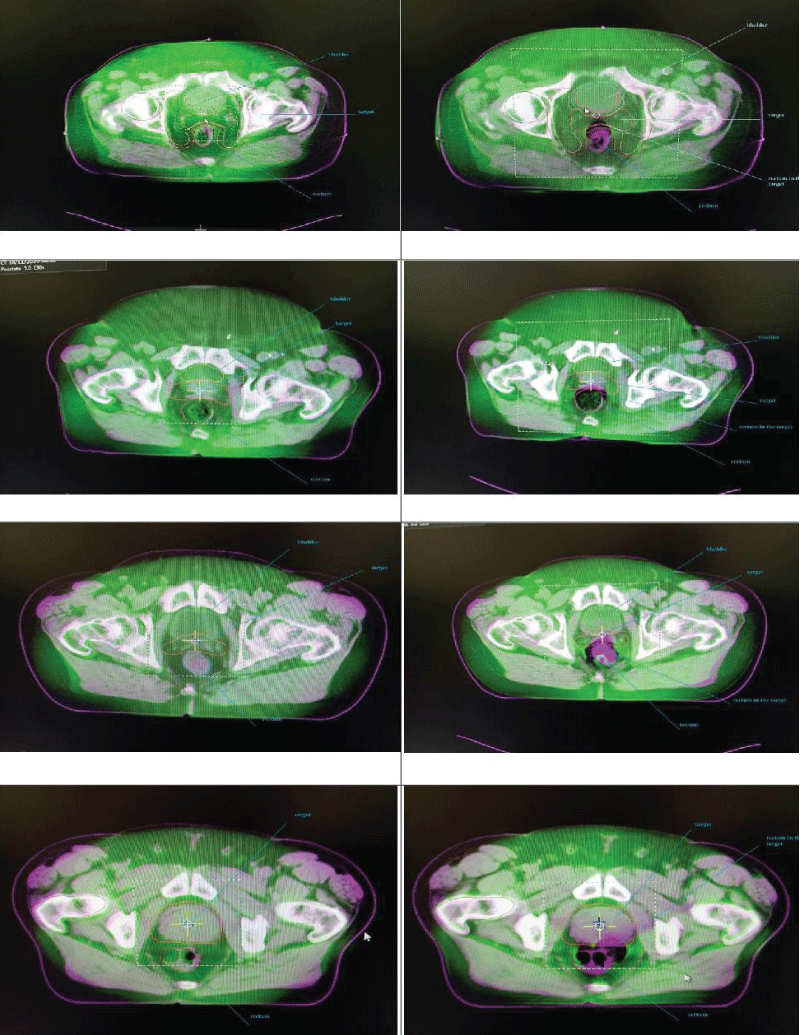 Cone Beam Computed Tomography (CBCT). Subjects following fiber- and fat-free diet-only.