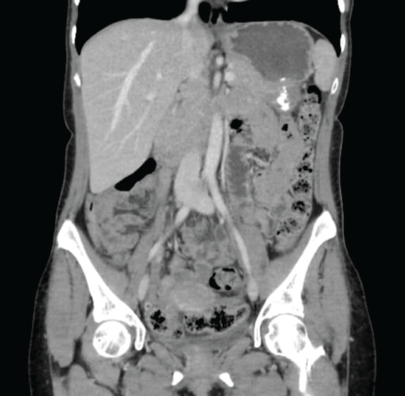 Postsurgical changes in the pelvic area concerning bilateral oophorectomy. Complete disappearance of previously existing ascites.