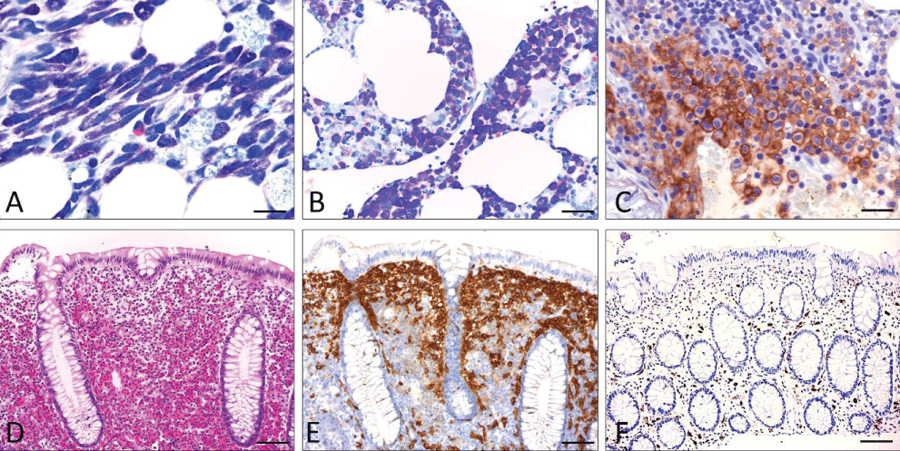 Basic features of SM (A-C; bone marrow infiltrate and D-F; infiltrate of the colon). A) Systemic mastocytosis (undifferentiated subtype). (Giemsa stain): Compact infiltrate consisting of > 15 mast cells exhibiting both spindle shape and moderate hypogranulation. B) Systemic mastocytosis (well-differentiated subtype) (Giemsa stain): Compact infiltrate consisting of >15 mast cells showing both exclusive roundness of the cytoplasm and signs of hypergranulation. C) Anti-CD25 immunohistochemistry: Compact mast cell infiltrates in systemic mastocytosis involving the bone marrow. Strong aberrant expression of CD25 by atypical mast cells. Note the specific annular, membrane-associated immunostaining. D-F) Systemic (intestinal) mastocytosis mimicking eosinophilic colitis with mast cells exhibiting an incomplete-aberrant immunophenotype.  D) H&E stain: Lamina propria mucosae is filled with densely packed mature eosinophilic granulocytes leading to an initial diagnosis of „eosinophilic colitis“. E) Anti-CD117 immunohistochemistry: Immunostaining reveals CD117-expressing mast cells forming compact band-like infiltrates in a subepithelial position. F) Anti-tryptase immunohistochemistry: The number of tryptase-expressing mast cells is low obviously reflecting those mast that do not belong to the neoplastic clone.  Scale bar A-C 5 m; D-F 50 m.