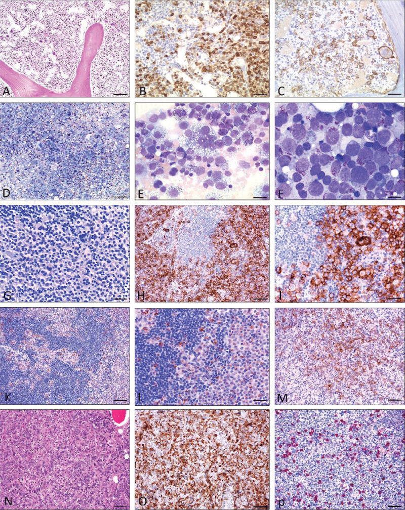 Mast cell leukemia with coexisting AML (A-E), Mast cell sarcoma (G-M), and differential diagnosis myelomastocytic leukemia (F) (19) and (N-P) chronic basophilic leukemia. A) H&E stain: Markedly hypercellular bone marrow diffusely infiltrated by medium-sized blastoid cells. Some loosely scattered megakaryocytes are also shown. Dilated sinuses. B) Anti-tryptase immunohistochemistry: Immunostaining reveals abundant tryptase-positive cells. C) Anti-CD30 immunohistochemistry: Many tumor cells including multinucleated large cells co-express CD30. D -E) Pappenheim stain: Bone marrow smear reveals marked hypercellularity. Higher magnification (E) shows atypical mast cells with vacuolated cytoplasm and metachromatic granules including multinucleated forms accounting for more than 20% of nucleated cells. F: Myelomastocytic leukemia (Pappenheim stain) The bone marrow smear shows an abundance of blast cells with large pale nuclei and few intracytoplamatic metachromatic granules (= metachromatic blast cells). G-M; Mast cell sarcoma:  G (Giemsa stain) Tissue from a large intraabdominal mass lesion with clinical suspicion of malignant lymphoma. Conventional staining at first glance is consistent with such a diagnosis, however, only CD117 (H; I) was expressed by tumor cells, and all lymphocytic markers were negative. Additional immunohistochemistry with anti-tryptase (K, L) finally revealed the mast cell nature of the tumor. M) Anti-CD30 immunohistochemistry: A significant proportion of the tumour cells expressed CD30, which could easily have led to a false diagnosis of lymphoma. N-P; Chronic basophilic leukemia in blast crisis (CBL-BC) (N); H&E staining: Bone marrow is extremely hypercellular with focal infiltrates of blastoid cells, strongly expressing CD61 (O). In other parts of the bone marrow, mature granulocytes expressing tryptase are detected (P). Scale bar A-D and G-P 50 m; E-F 5 m.