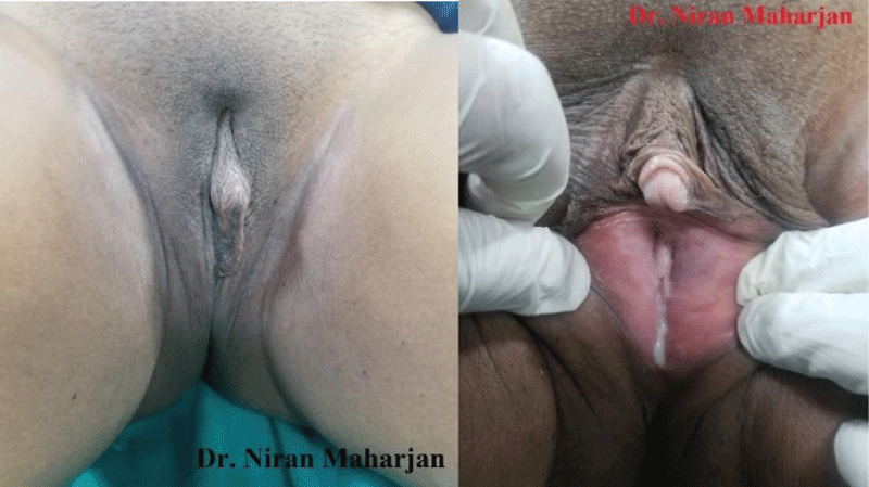 Pre-op in normal and opened labia majora.